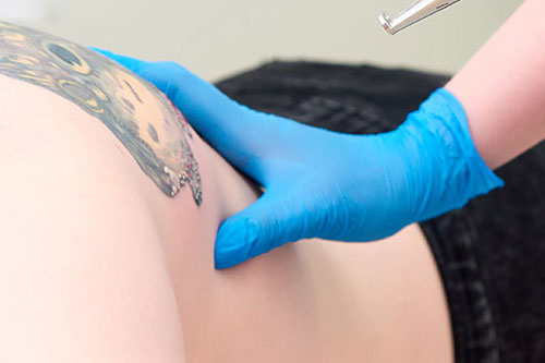 rimozione tatuaggi