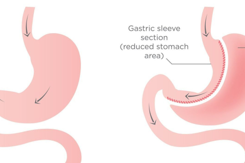 sleeve-gastrectomy-4c